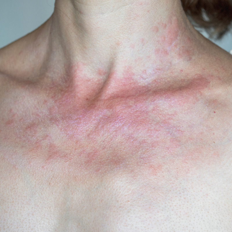 Common Skin Conditions