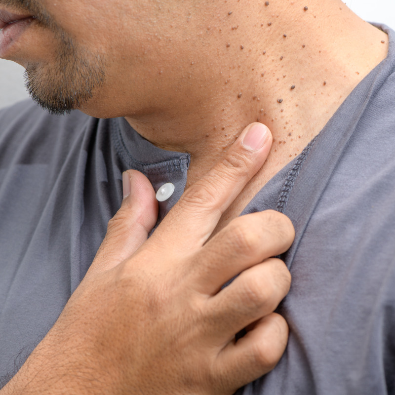 Skin Tags and Mole Removal